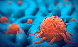 Yumurtalık kanseri tedavisinde yeni gelişme: Hücrelere zarar vermiyor