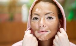 Vitiligo nedir? Vitiligo tedavi yöntemleri neler?