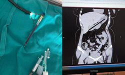 Doktorlar da şaşkın: Genç kadının midesinden çıkanlar şoke etti