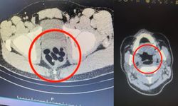 Polis şok oldu: 27 yaşındaki kadının midesinden bakın ne çıktı