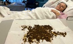 Türkiye'de nadir rastlanan vaka! Karın ağrısıyla gitti 20 binden fazla taş çıktı