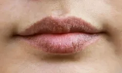 Kış aylarında dudak çatlakları kabusunuz olmasın: İşte her evde bulunan malzemelerle etkili yöntemler