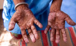 2 ülkede cüzzam vakaları görülmeye başladı