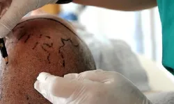 Saç ekimi ölümle sonuçlandı: Olayla ilgili soruşturma başlatıldı