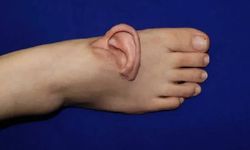 Dünya’da bir ilk: Doktorlar kulağı yaşatmak için ayağa dikti