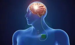 Parkinson hastalığı tedavisinde beyin pili yöntemi başarılı sonuç verebiliyor