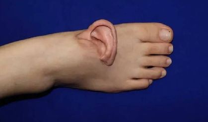 Dünya’da bir ilk: Doktorlar kulağı yaşatmak için ayağa dikti