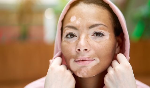 Vitiligo nedir? Vitiligo tedavi yöntemleri neler?