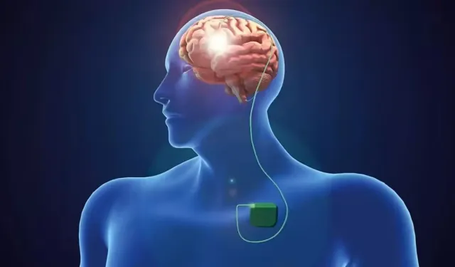 Parkinson hastalığı tedavisinde beyin pili yöntemi başarılı sonuç verebiliyor