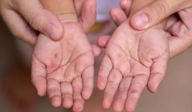 Bangladeş’te kızamık alarmı: 409 çocuk hayatını kaybetti