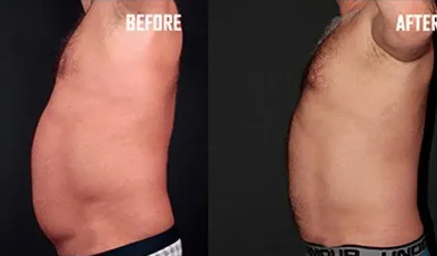 Liposuction: Fazla yağlardan kurtulmanın popüler yolu