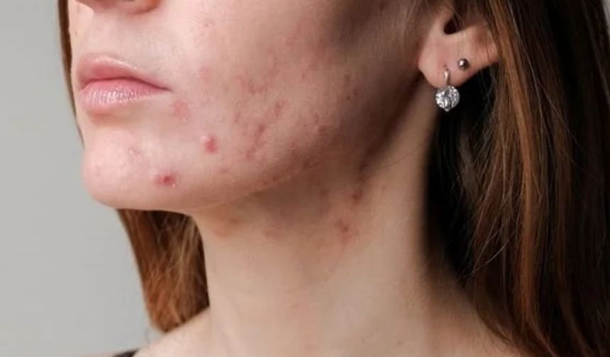 Ciltte sivilce neden çıkar? Sivilceye ve izlerine ne iyi gelir?