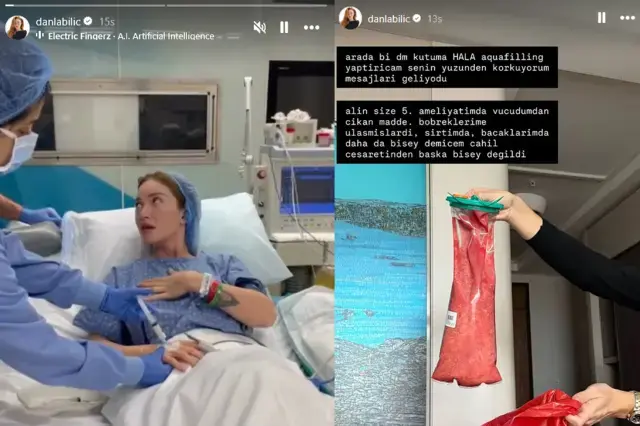 Danla Biliç 5. Kez Ameliyat Oldu! Çıkan Dolgu Maddesini Paylaştı