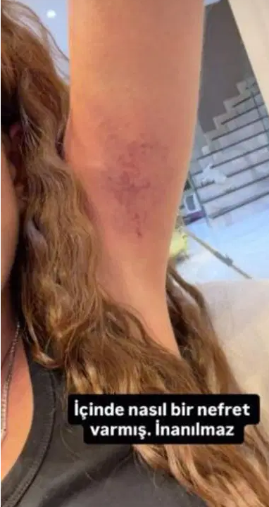 Sıla Doğu kardeşi Dilan Polat'ı fena  dövdü: Saçlarını kopardı, kollarını morarttı