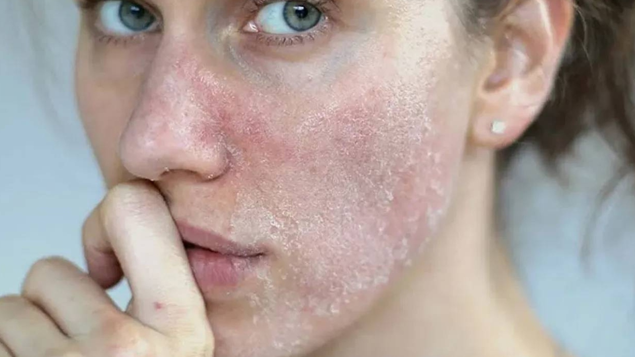 Kış Aylarında Yüz Kuruluğuna Ne Iyi Gelir Cilt Kuruluğu Neden Olur (3)